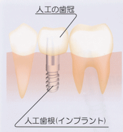 インプラントの詳細