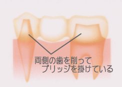 インプラントの詳細