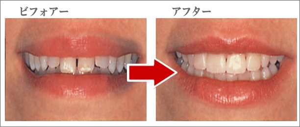 審美歯科（ラミネート法）