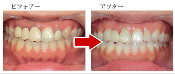 審美歯科（ジルコニア・セラミッククラウン法）