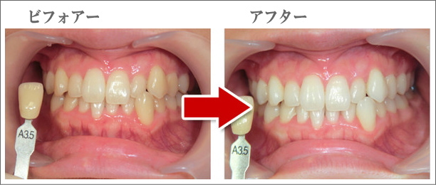 ホワイトニング